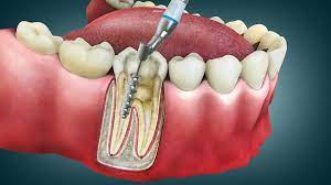 Endodontics (Root Canal Treatment)